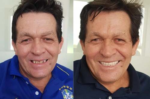 Implante Antes e Depois