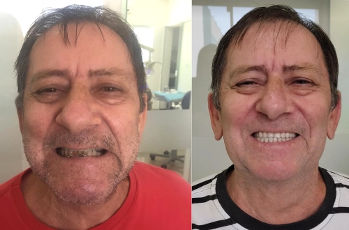 Implante Antes e Depois