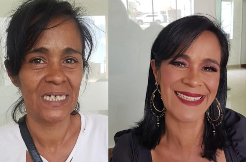 Implante Antes e Depois