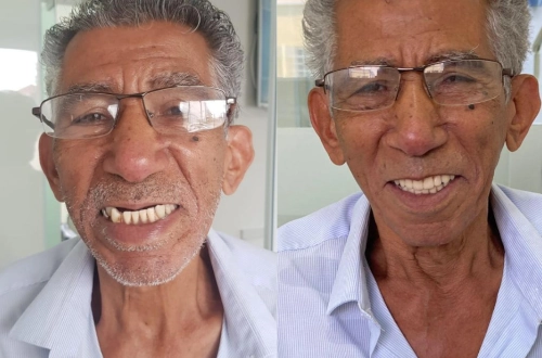 Implante Antes e Depois